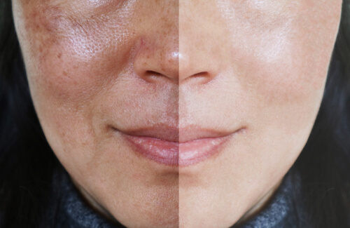 how to get rid of skin discoloration