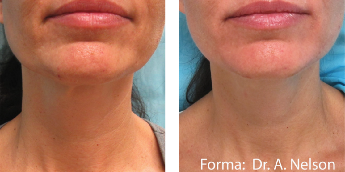 Before & After Photos Subdermal Skin Tightening 3